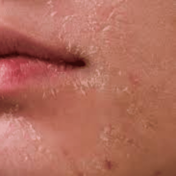 چرا در پاییز پوست خشک میشود؟