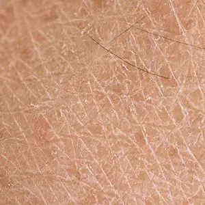 علت خشکی پوست و خارش